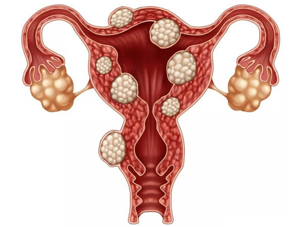 卵巢肿瘤通常在37周进行手术