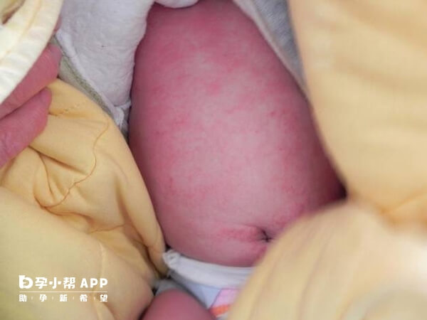 新生儿痤疮通常在出生3到4周出现