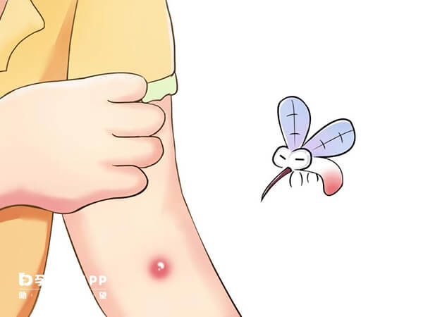 丘疹性荨麻疹又称为虫咬性皮炎
