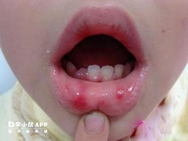 嘴唇长溃疡会影响宝宝进食