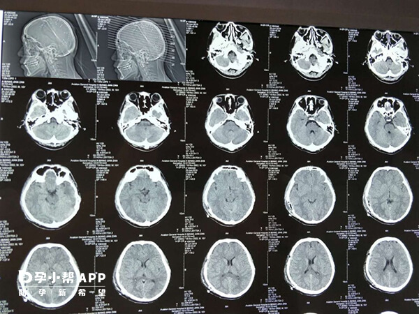 宝宝摔跤后出现异常需要做头颅ct