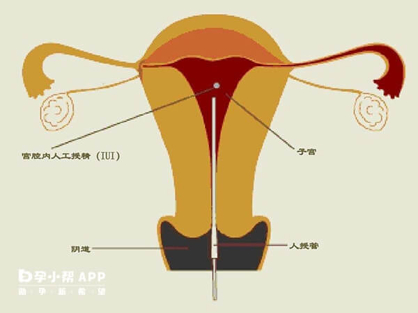 输卵管通畅可以直接做人工授精