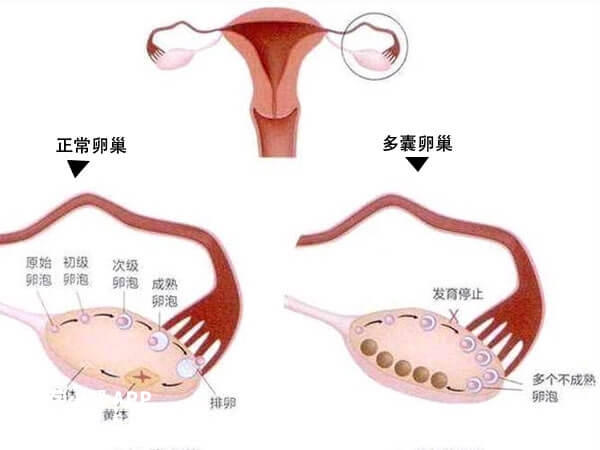 当amh高于正常范围可判定为多囊卵巢