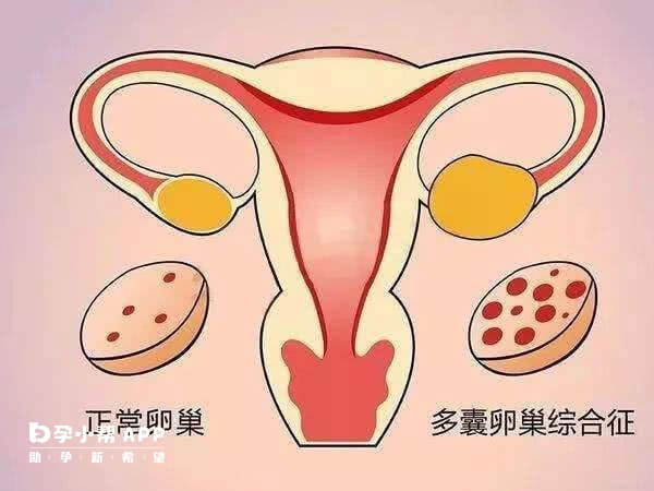 amh偏高很有可能为多囊患者建议尽早去医院详细检查