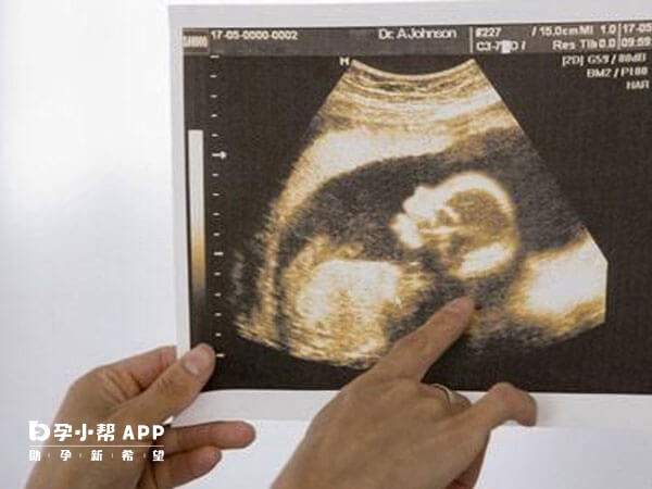 胎儿双顶径偏大是胎儿发育偏大的表现