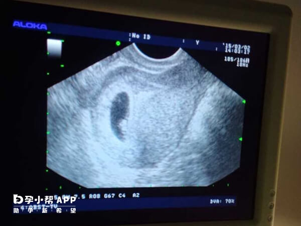 b超检查能看见子宫是否有孕囊