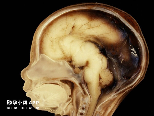大头症宝宝脑部图片