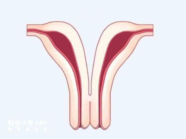 子宫畸形是胎儿时期发育异常导致的