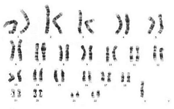 特纳综合征是染色体异常疾病