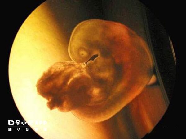 胚胎生化会出现妊娠反应减轻的症状