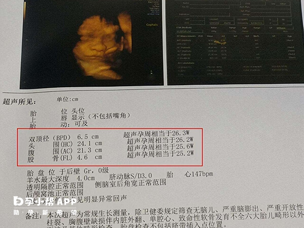 双顶径公式算男女准确度不高