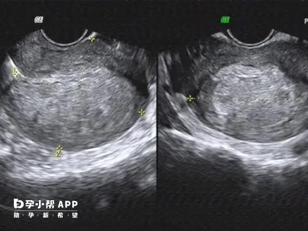 超声检测子宫内膜可以确定移植窗口期