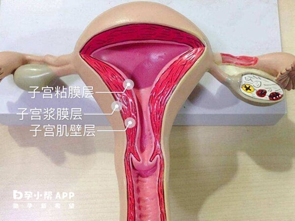 子宫内膜薄需要进行宫腔灌注