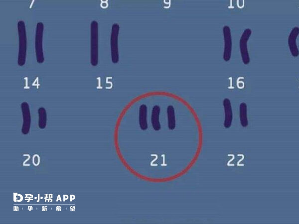 21号染色体异常一般无法治疗