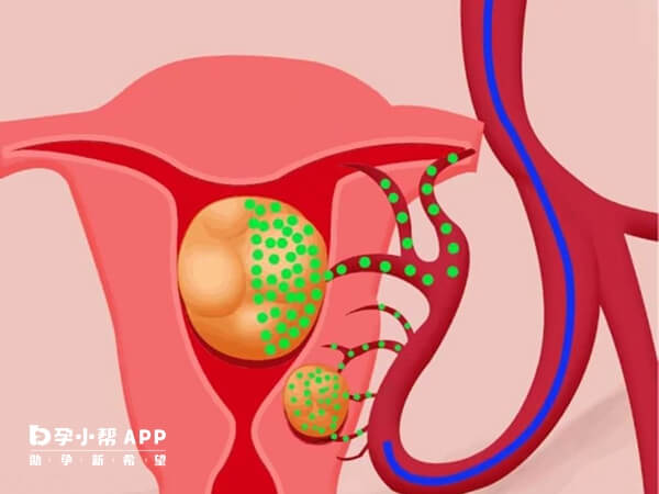 有子宫肌瘤会影响供卵试管成功率