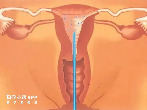 人工授精是将精子直接注入女性宫腔