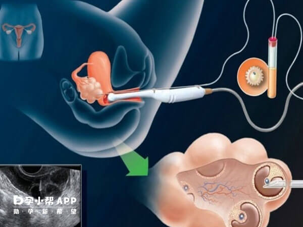 胚胎移植过程图解