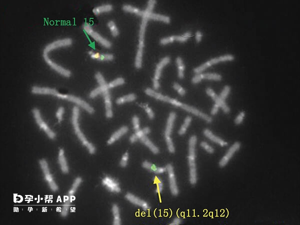 染色体微阵列又叫基因芯片
