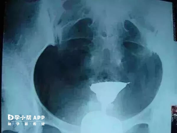双侧输卵管近端梗阻造影显影图示