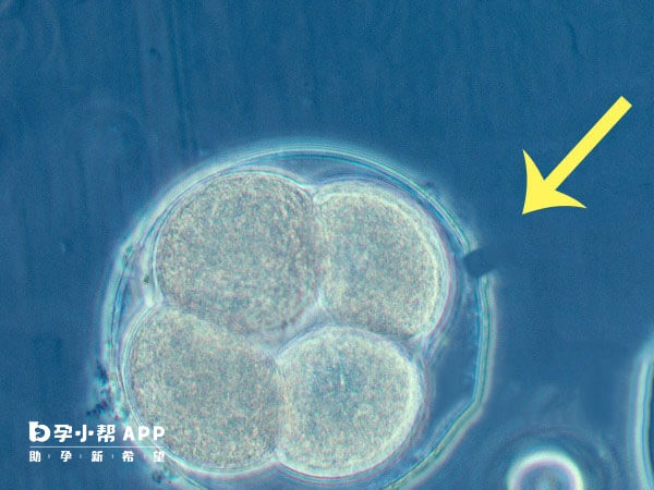 辅助孵化是人为帮助胚胎孵化出透明带