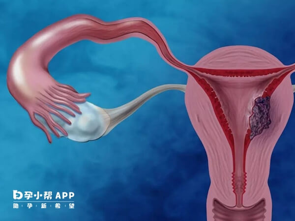 多囊卵巢是生殖内分泌代谢性疾病