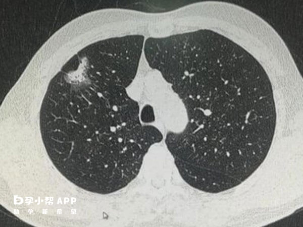 肺部结节需要定期复查