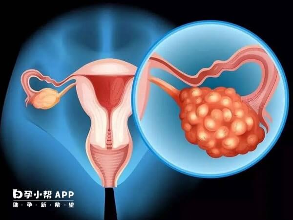 多囊卵巢综合症影响生育
