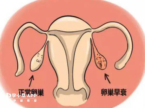 人胎盘片可以治疗卵巢早衰