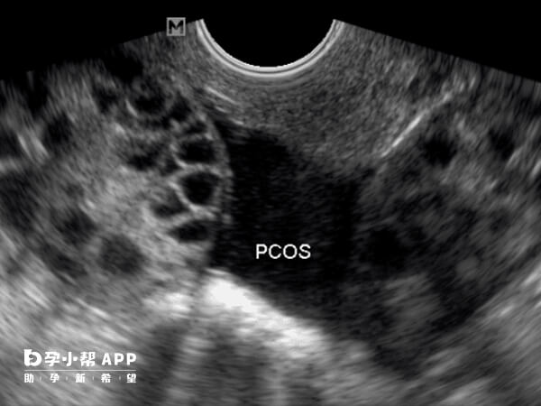 b超提示卵巢多囊样改变