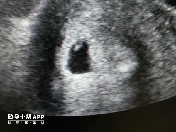 试管移植后第28天胎心结构发育还不完善