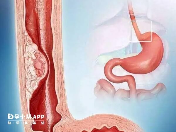 食管炎常见的病因就是胃食管反流病