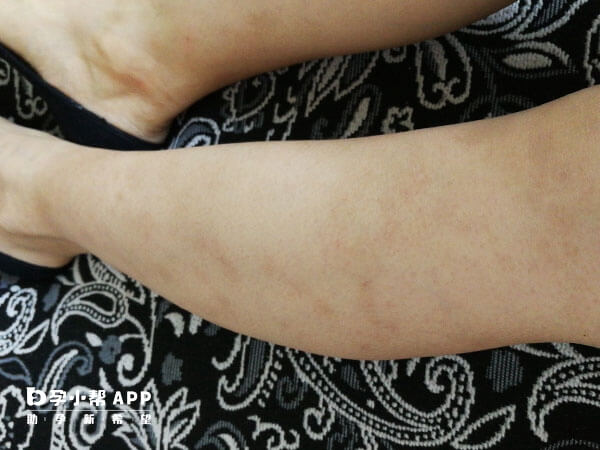结节性痒疹是皮肤病