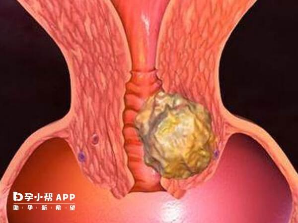 子宫内膜癌逆转成功后可通过辅助生殖助孕
