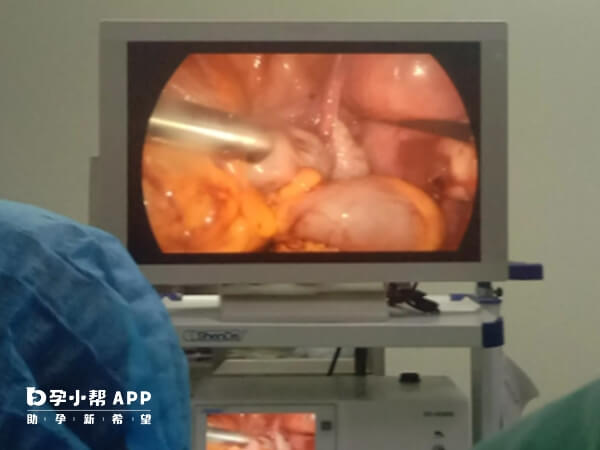 腹腔镜手术疏通输卵管对身体伤害不大