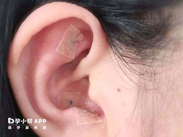 耳针贴是从中医角度对试管提供帮助