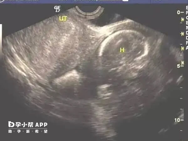 Ⅰ型残角子宫多于合并妊娠时发现