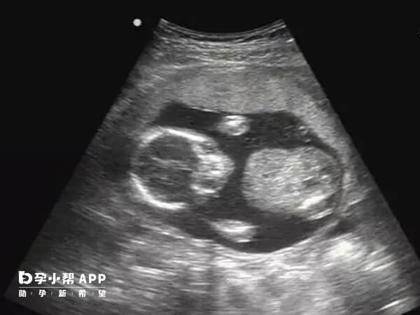 Ⅰ型残角子宫多于合并妊娠时发现