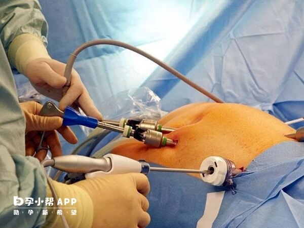 残角子宫手术可选择腹腔镜微创