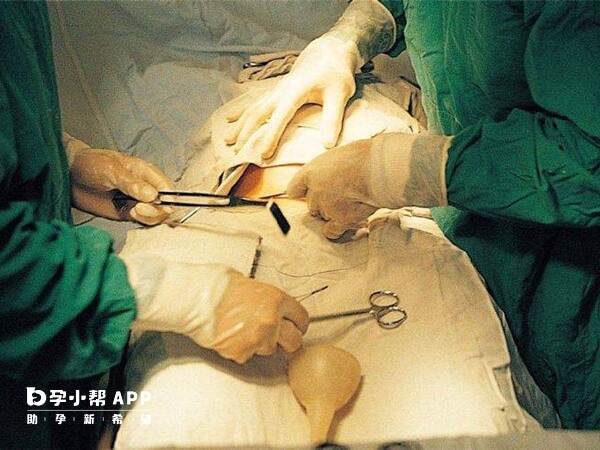 剖宫产费用手术操作费用在2000到3000元