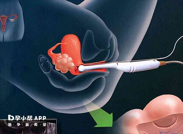 宫颈口松移植胚胎容易掉出来吗？