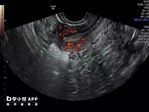 内膜血流二级可以正常移植冻囊胚