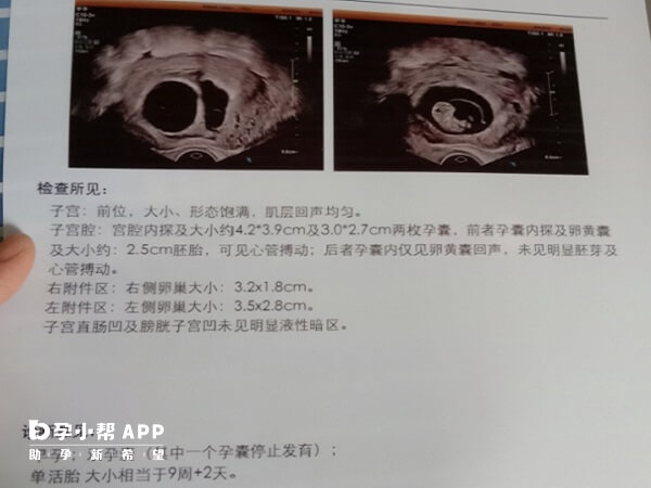 双胎早期容易胎停一个可能是因为染色体异常