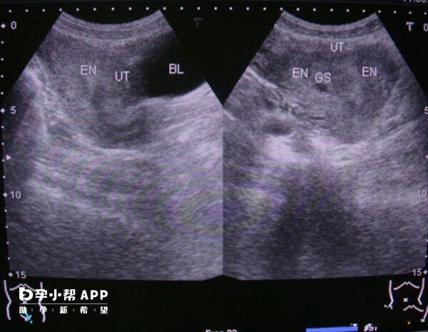纵膈子宫可以通过输卵管造影检查出来