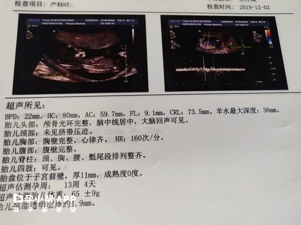 NT检查是孕期评估胎儿是否患有唐氏综合征的一种超声检查办法