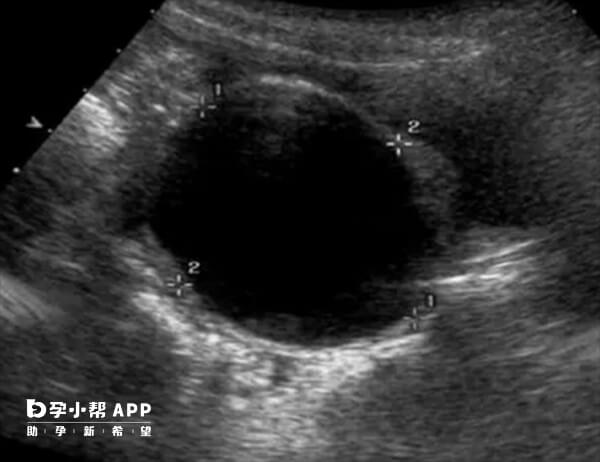 液性暗区表明有出血的情况