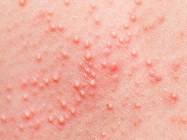 试管移植后湿疹犯了可以外涂红霉素药膏止痒吗？
