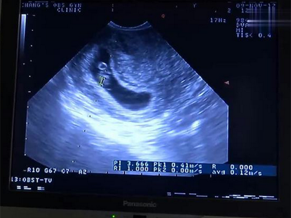 移植二十天做b超看到孕囊吗？附胚胎、囊胚着床胚囊出现时间