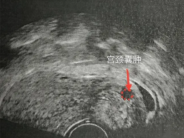 宫颈部位有纳氏囊肿能做试管婴儿怀上宝宝吗？