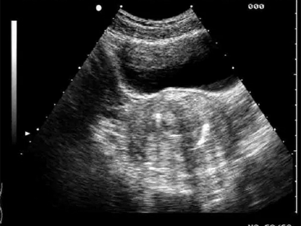 完全性纵隔子宫试管婴儿移植2个胚胎后能怀双胎吗？