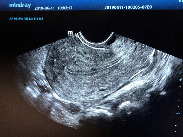 子宫内膜B型厚0.3能做试管婴儿移植吗？成功率有多高？
